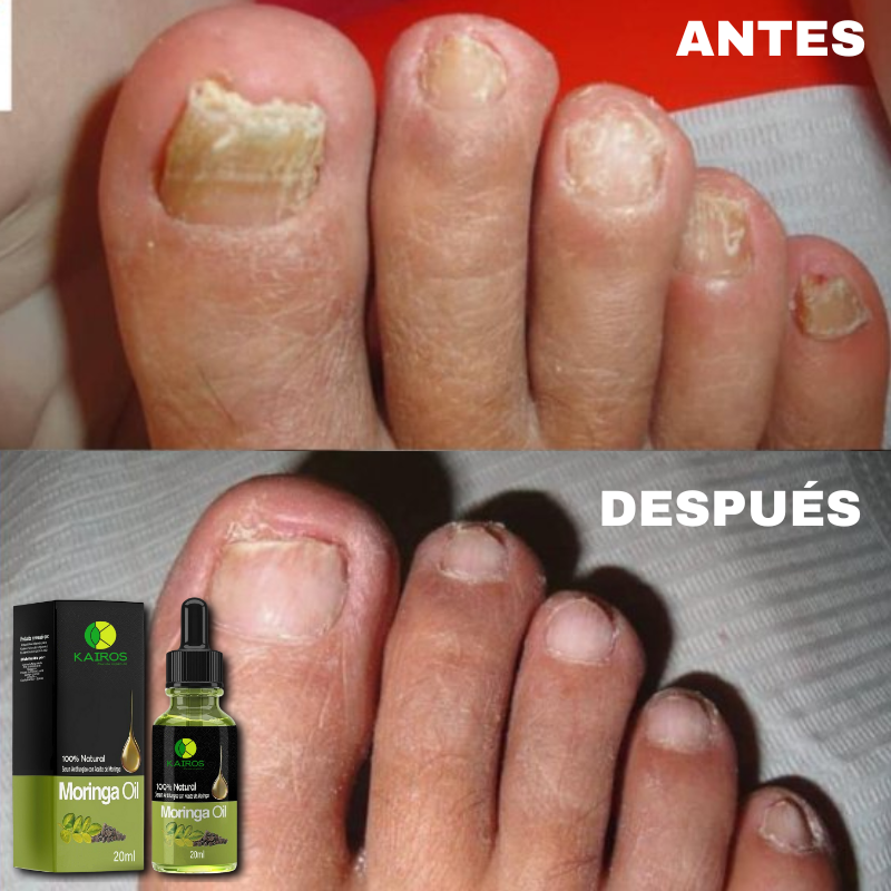 Sérum Antifúngico de Moringa - Elimina Hongos en Uñas