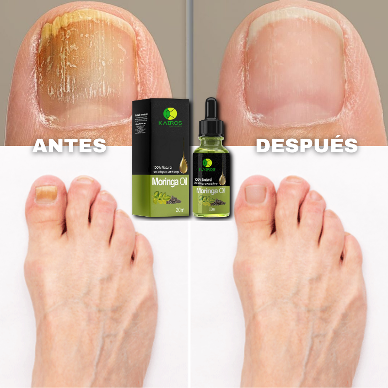 Sérum Antifúngico de Moringa - Elimina Hongos en Uñas